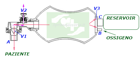 Qual'ora la pressione della ventilazione risulti eccessiva o le vie aeree del paziente siano ostruite la valvola V2 fa uscire l'aria in eccesso